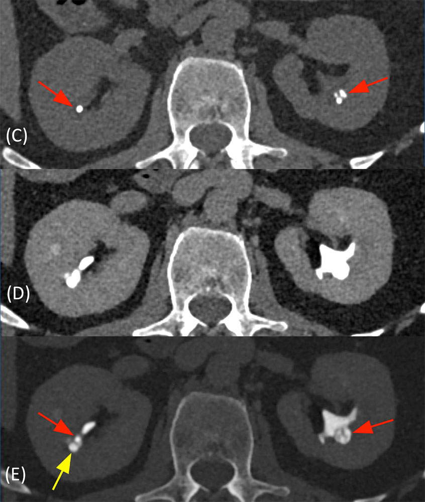 Genitourinary Learning Modules Ct Scanning